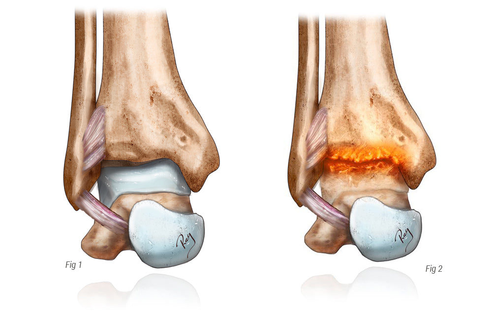 Ankle Osteo-Arthritis