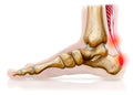 Achillespees tendinopathie