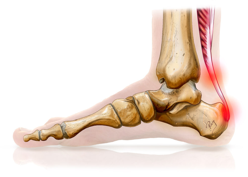 Achilles tendinopathy