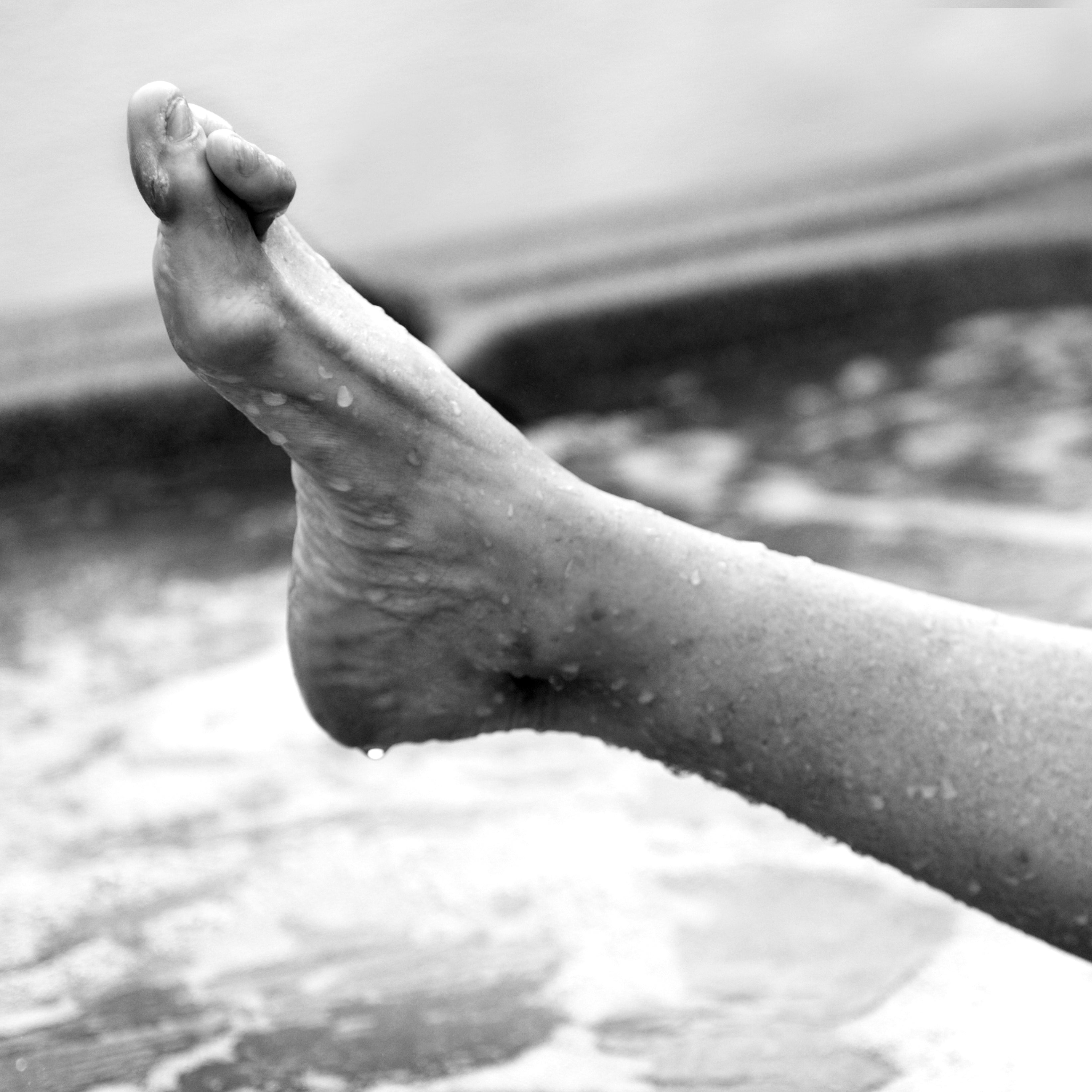 Hammertoe