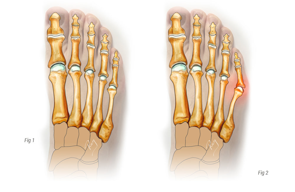 Bunionette or Tailor's bunion
