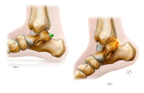 Enkelimpingement