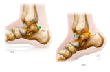 Ankle Impingement