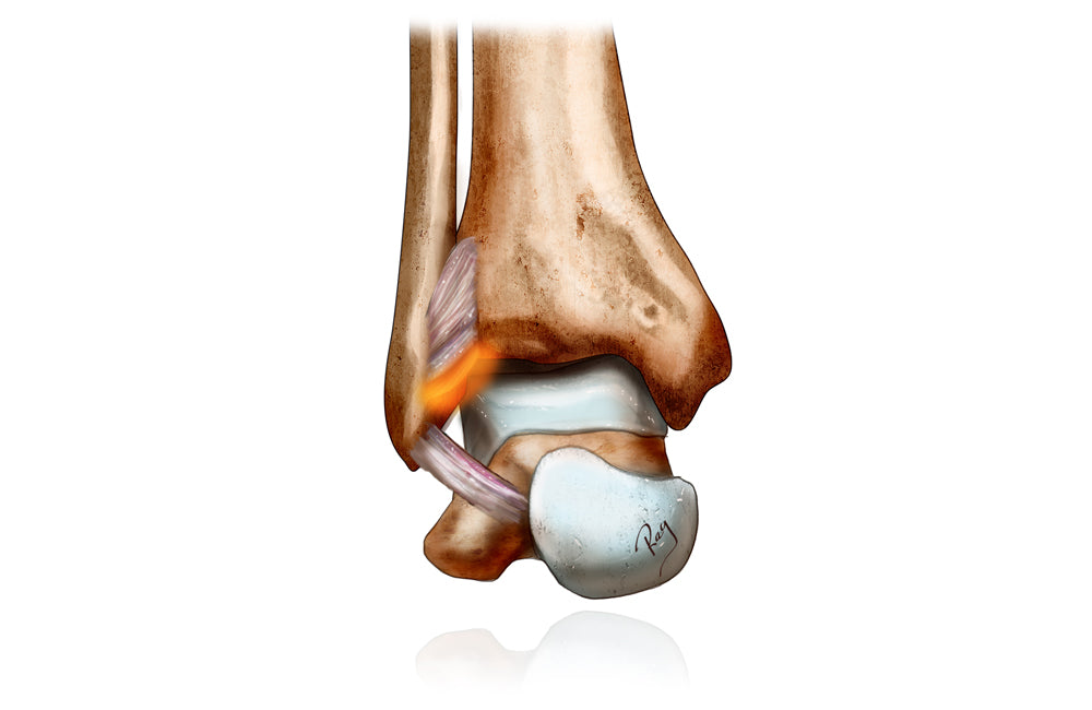 Ankle Impingement