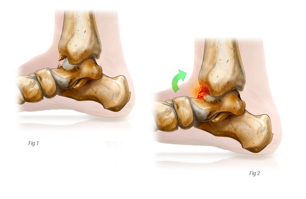 Ankle Impingement