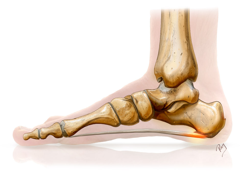 Plantar fasciitis