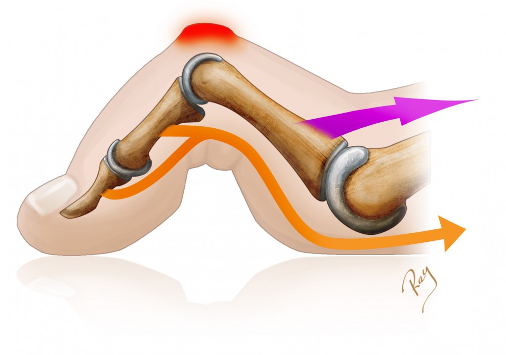 Hammertoe