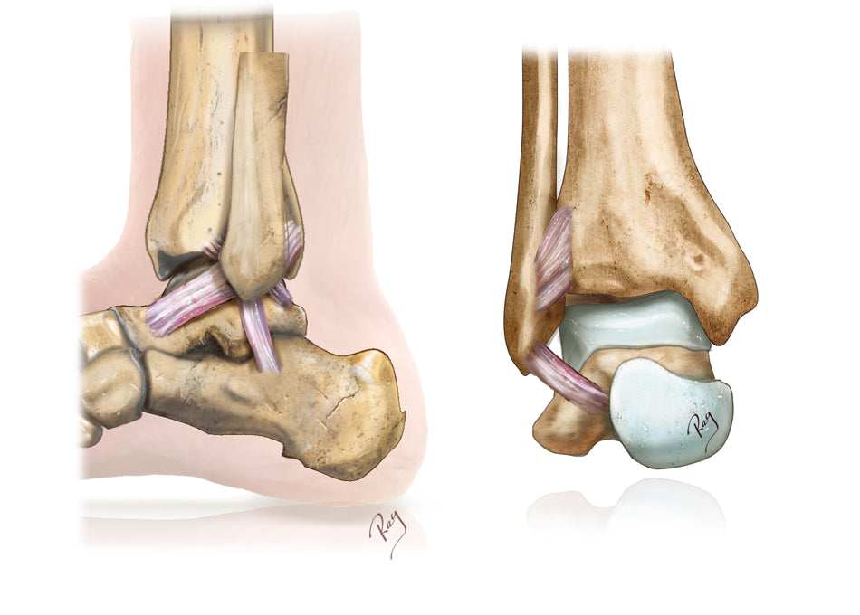 Ankle Instability