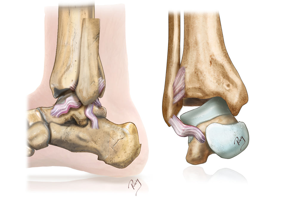 Ankle Instability