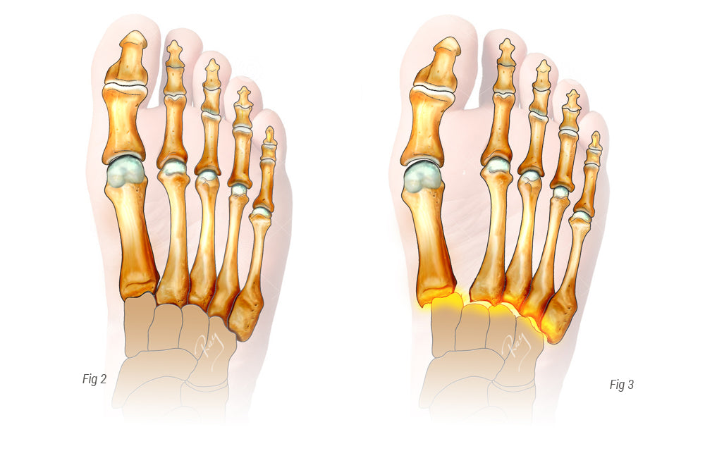 Lisfranc injuries