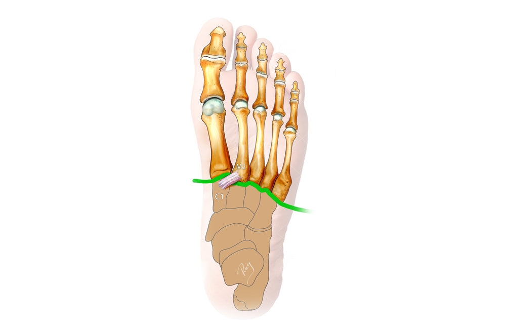 Lisfranc injuries