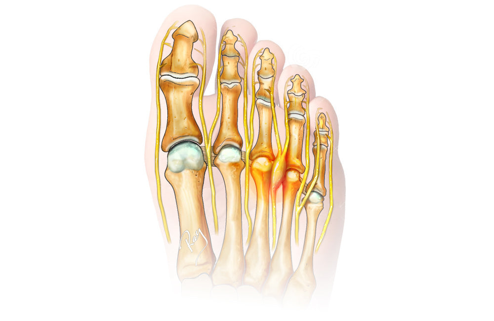 Morton's Neuroma