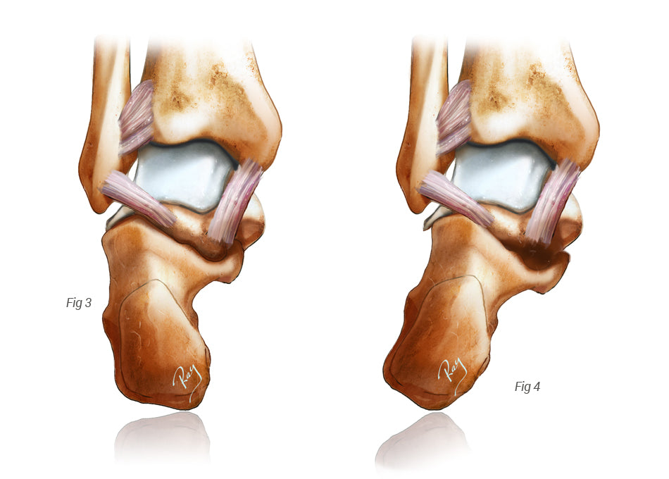 Flat Foot
