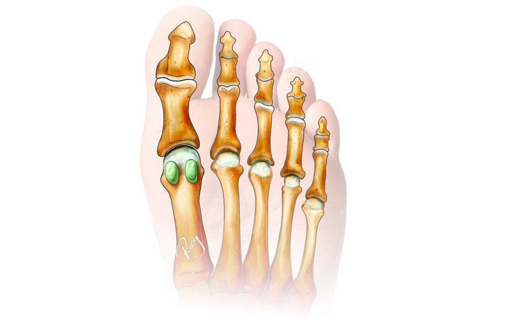 Sesamoid Injuries